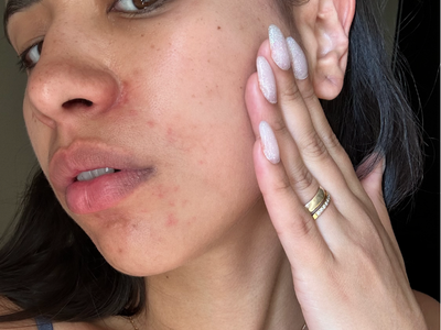 Skin irritation, perioral dermatitis, women's skincare, skincare issues, skin reaction